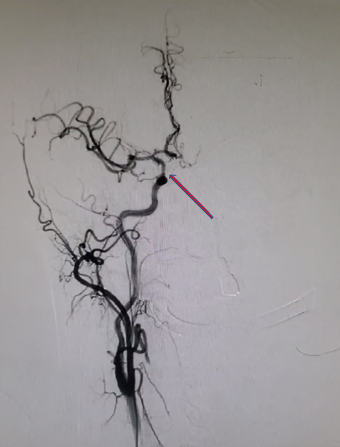 导丝怎么扩【载药时代 球扩天下】NOVA DES®颅内药物洗脱支架在颈内动脉颅内段重度狭窄的应用两例！滕州市中心医院&山西医科大学第二医院_https://www.jmylbn.com_新闻资讯_第21张
