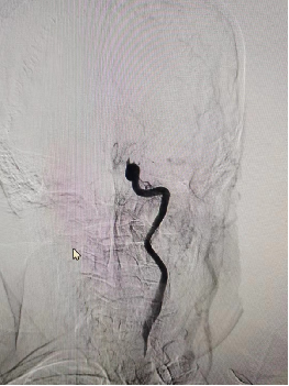 导丝怎么扩【载药时代 球扩天下】NOVA DES®颅内药物洗脱支架在颈内动脉颅内段重度狭窄的应用两例！滕州市中心医院&山西医科大学第二医院_https://www.jmylbn.com_新闻资讯_第4张