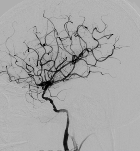 导丝怎么扩【载药时代 球扩天下】NOVA DES®颅内药物洗脱支架在颈内动脉颅内段重度狭窄的应用二例！_https://www.jmylbn.com_新闻资讯_第20张