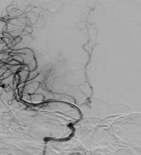 导丝怎么扩【载药时代 球扩天下】NOVA DES®颅内药物洗脱支架在颈内动脉颅内段重度狭窄的应用二例！_https://www.jmylbn.com_新闻资讯_第18张