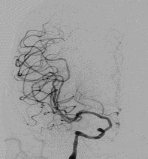 导丝怎么扩【载药时代 球扩天下】NOVA DES®颅内药物洗脱支架在颈内动脉颅内段重度狭窄的应用二例！_https://www.jmylbn.com_新闻资讯_第19张
