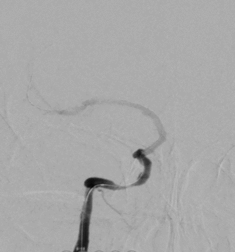 导丝怎么扩【载药时代 球扩天下】NOVA DES®颅内药物洗脱支架在颈内动脉颅内段重度狭窄的应用二例！_https://www.jmylbn.com_新闻资讯_第13张