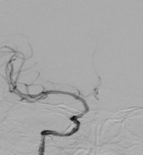 导丝怎么扩【载药时代 球扩天下】NOVA DES®颅内药物洗脱支架在颈内动脉颅内段重度狭窄的应用二例！_https://www.jmylbn.com_新闻资讯_第17张