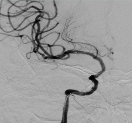 导丝怎么扩【载药时代 球扩天下】NOVA DES®颅内药物洗脱支架在颈内动脉颅内段重度狭窄的应用二例！_https://www.jmylbn.com_新闻资讯_第15张