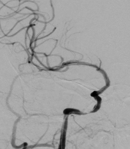 导丝怎么扩【载药时代 球扩天下】NOVA DES®颅内药物洗脱支架在颈内动脉颅内段重度狭窄的应用二例！_https://www.jmylbn.com_新闻资讯_第14张