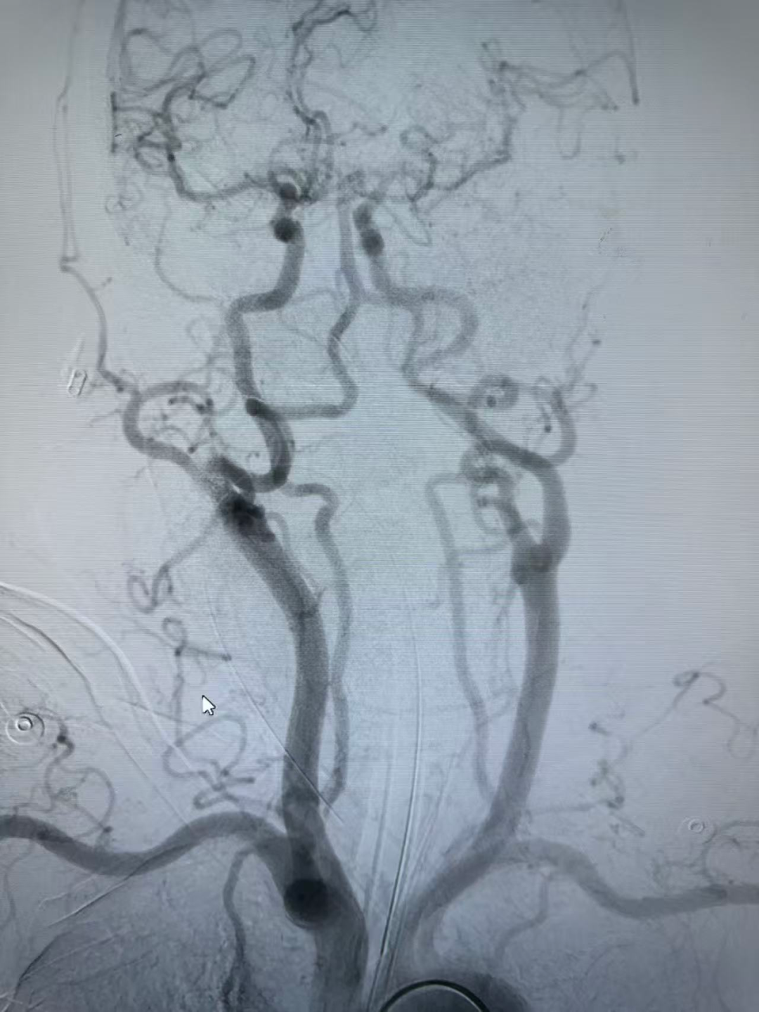 动脉长鞘怎么置入健谈•一鞘双能｜温昌明教授团队：BMAX088球囊长鞘治疗左侧大脑中动脉闭塞一例_https://www.jmylbn.com_新闻资讯_第6张