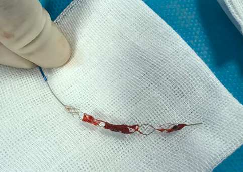 动脉长鞘怎么置入健谈•一鞘双能｜温昌明教授团队：BMAX088球囊长鞘治疗左侧大脑中动脉闭塞一例_https://www.jmylbn.com_新闻资讯_第11张