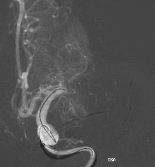 动脉长鞘怎么置入健谈•一鞘双能｜温昌明教授团队：BMAX088球囊长鞘治疗左侧大脑中动脉闭塞一例_https://www.jmylbn.com_新闻资讯_第7张