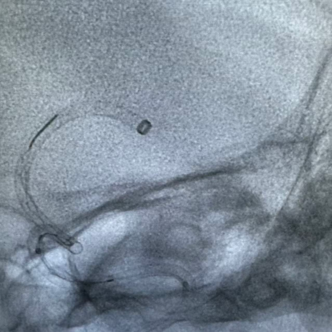 动脉长鞘怎么置入健谈•一鞘双能｜温昌明教授团队：BMAX088球囊长鞘治疗左侧大脑中动脉闭塞一例_https://www.jmylbn.com_新闻资讯_第10张