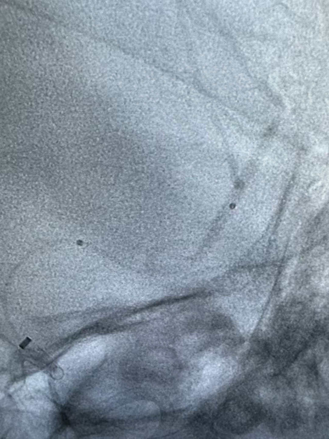 动脉长鞘怎么置入健谈•一鞘双能｜温昌明教授团队：BMAX088球囊长鞘治疗左侧大脑中动脉闭塞一例_https://www.jmylbn.com_新闻资讯_第8张