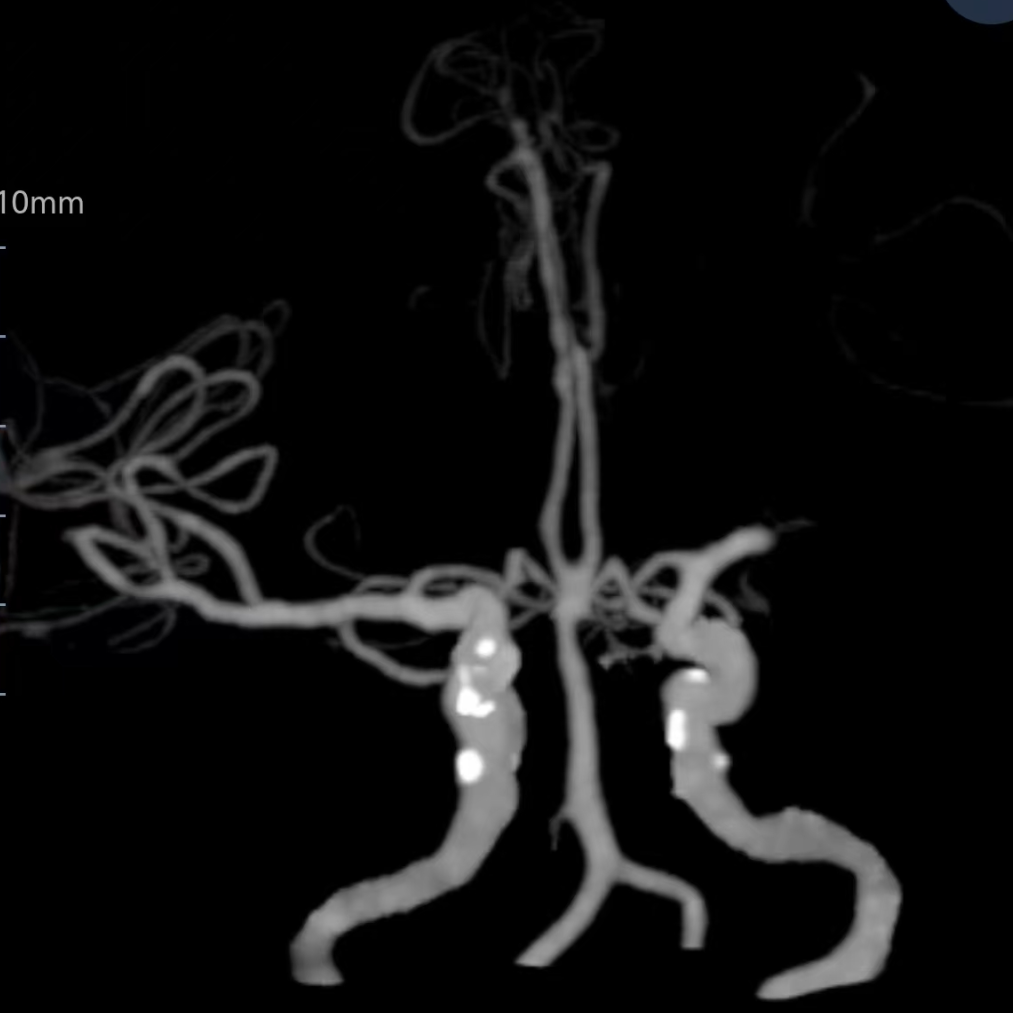 动脉长鞘怎么置入健谈•一鞘双能｜温昌明教授团队：BMAX088球囊长鞘治疗左侧大脑中动脉闭塞一例_https://www.jmylbn.com_新闻资讯_第5张