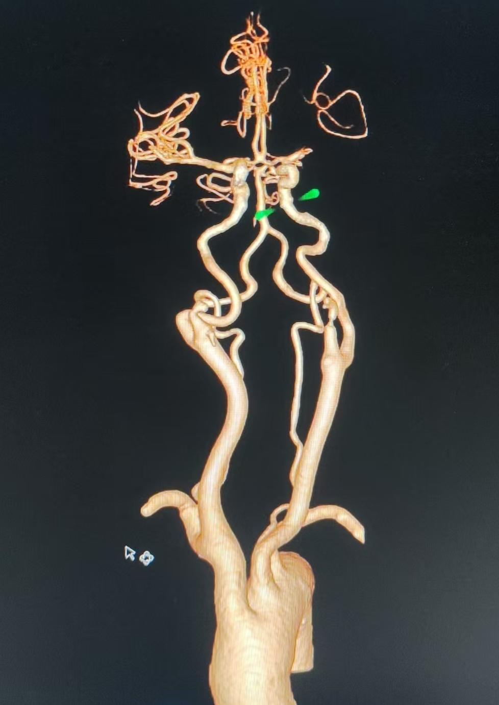 动脉长鞘怎么置入健谈•一鞘双能｜温昌明教授团队：BMAX088球囊长鞘治疗左侧大脑中动脉闭塞一例_https://www.jmylbn.com_新闻资讯_第4张
