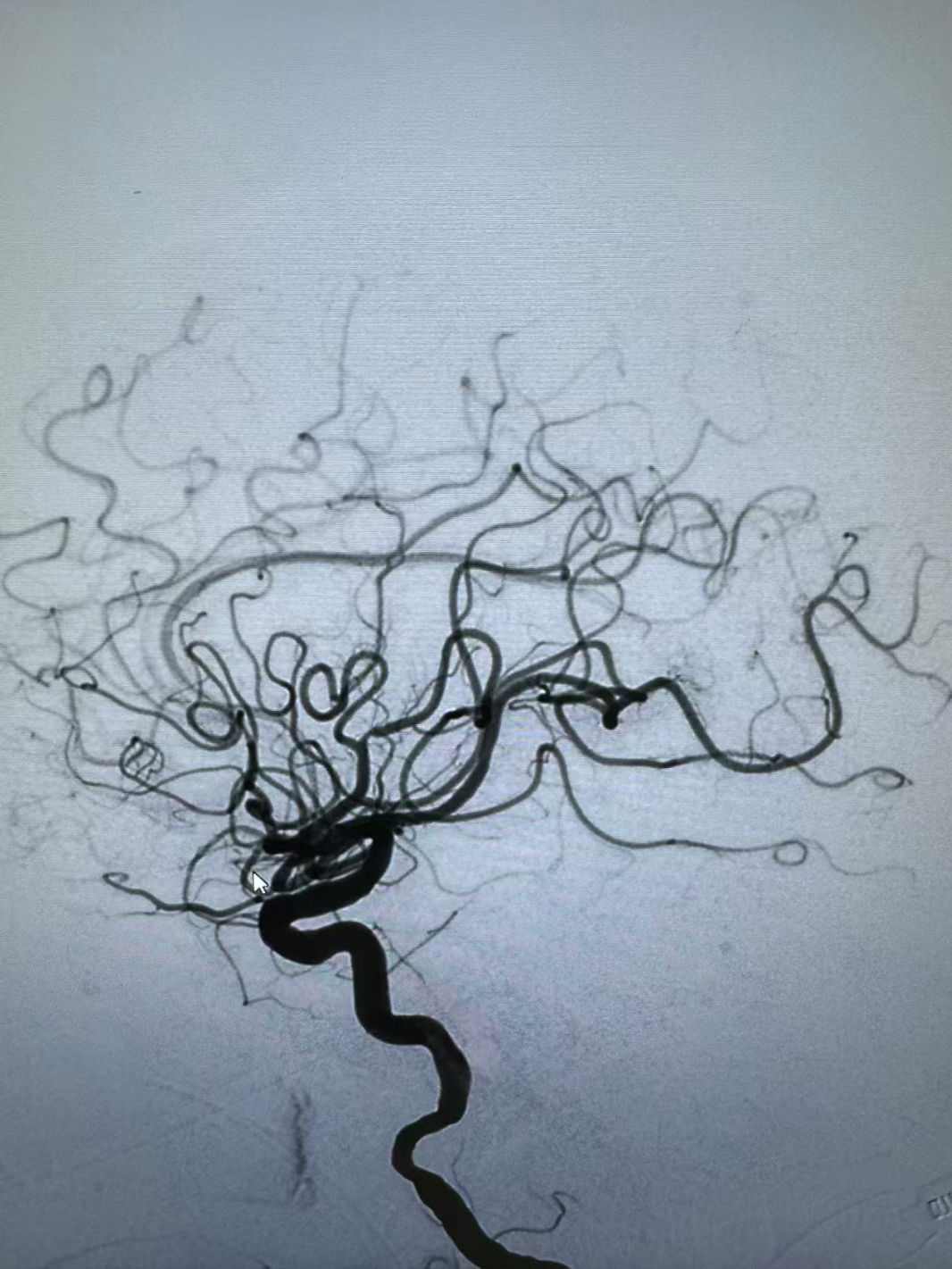 动脉长鞘怎么置入健谈•一鞘双能｜温昌明教授团队：BMAX088球囊长鞘治疗左侧大脑中动脉闭塞一例_https://www.jmylbn.com_新闻资讯_第13张