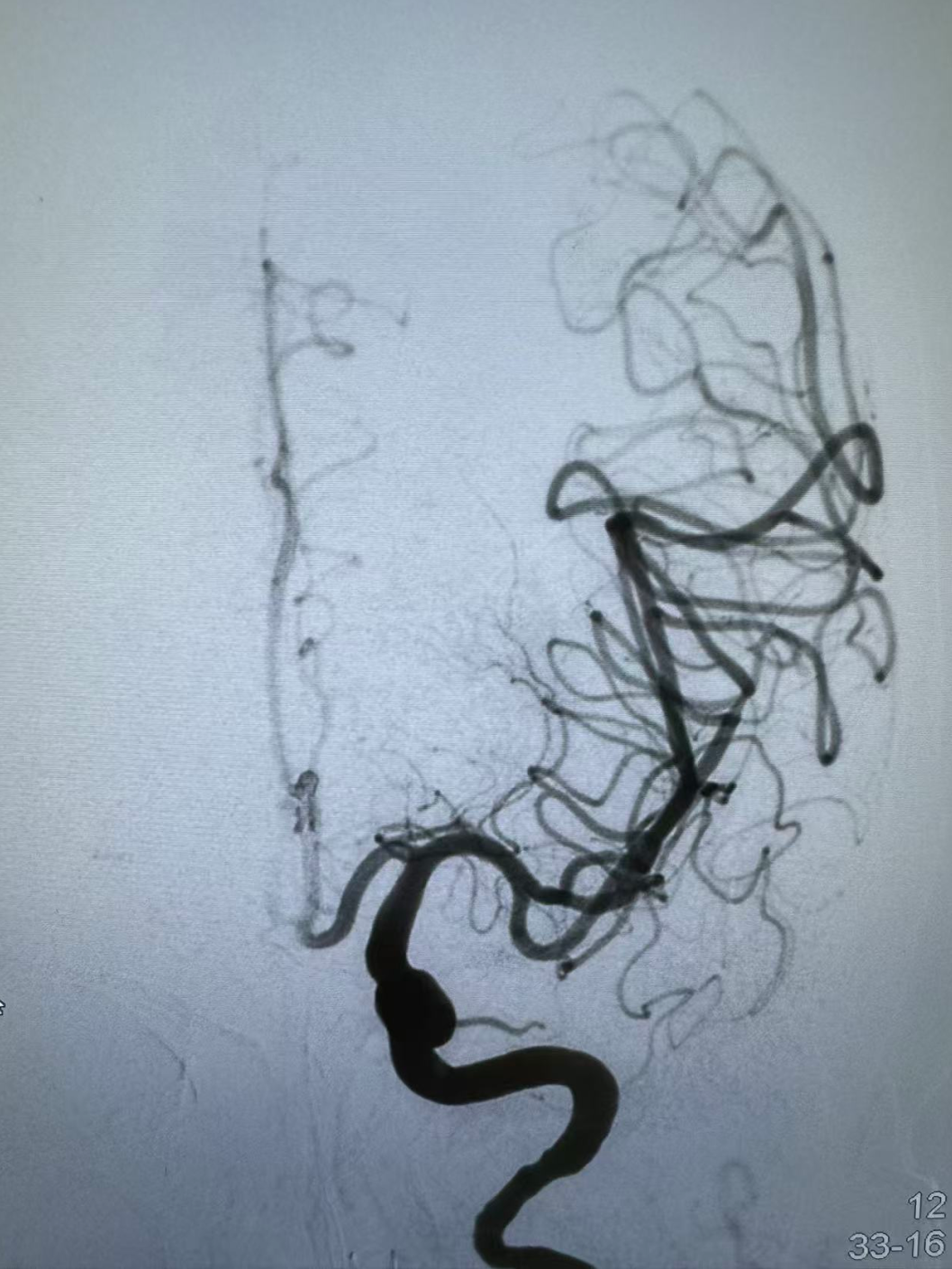 动脉长鞘怎么置入健谈•一鞘双能｜温昌明教授团队：BMAX088球囊长鞘治疗左侧大脑中动脉闭塞一例_https://www.jmylbn.com_新闻资讯_第12张