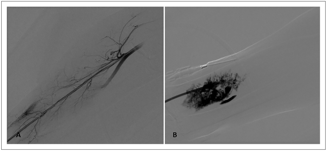 桡动脉鞘怎么读经桡动脉入路使用Simmons导引导管进行颈动脉支架置入术：单中心经验的可行性和手术并发症_https://www.jmylbn.com_新闻资讯_第8张
