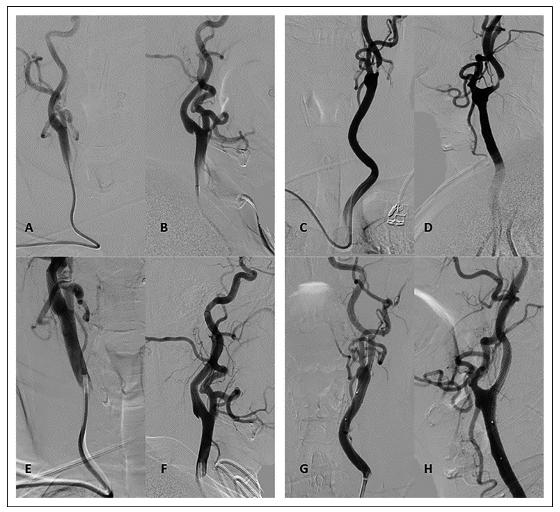 桡动脉鞘怎么读经桡动脉入路使用Simmons导引导管进行颈动脉支架置入术：单中心经验的可行性和手术并发症_https://www.jmylbn.com_新闻资讯_第3张