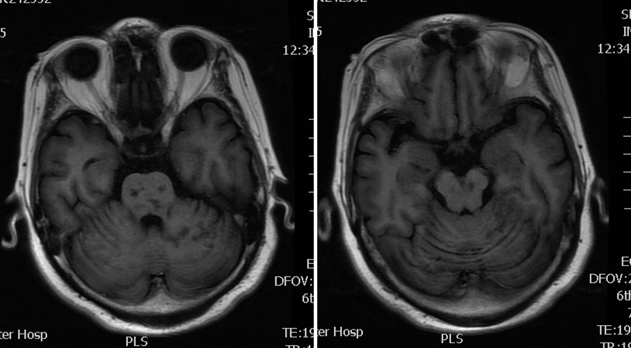 导丝怎么扩【载药时代 球扩天下】NOVA DES®颅内药物洗脱支架在基底动脉近端重度狭窄的应用—西安市中心医院使用体会一例！_https://www.jmylbn.com_新闻资讯_第9张