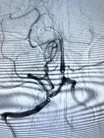 导丝怎么扩【载药时代 球扩天下】NOVA DES®颅内药物洗脱支架在基底动脉近端重度狭窄的应用—西安市中心医院使用体会一例！_https://www.jmylbn.com_新闻资讯_第7张