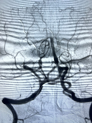 导丝怎么扩【载药时代 球扩天下】NOVA DES®颅内药物洗脱支架在基底动脉近端重度狭窄的应用—西安市中心医院使用体会一例！_https://www.jmylbn.com_新闻资讯_第6张