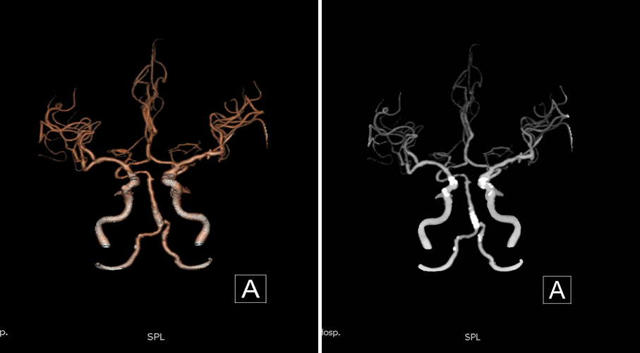 导丝怎么扩【载药时代 球扩天下】NOVA DES®颅内药物洗脱支架在基底动脉近端重度狭窄的应用—西安市中心医院使用体会一例！_https://www.jmylbn.com_新闻资讯_第10张
