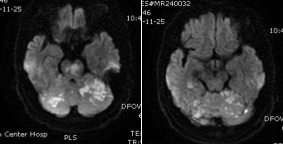 导丝怎么扩【载药时代 球扩天下】NOVA DES®颅内药物洗脱支架在基底动脉近端重度狭窄的应用—西安市中心医院使用体会一例！_https://www.jmylbn.com_新闻资讯_第5张