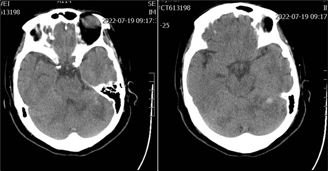 导丝怎么扩【载药时代 球扩天下】NOVA DES®颅内药物洗脱支架在基底动脉近端重度狭窄的应用—西安市中心医院使用体会一例！_https://www.jmylbn.com_新闻资讯_第8张