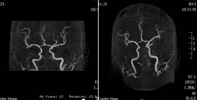 导丝怎么扩【载药时代 球扩天下】NOVA DES®颅内药物洗脱支架在基底动脉近端重度狭窄的应用—西安市中心医院使用体会一例！_https://www.jmylbn.com_新闻资讯_第4张