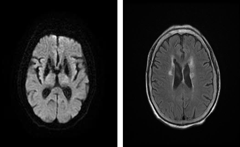导丝怎么扩重磅！NOVA颅内药物球扩支架湖北首例植入！_https://www.jmylbn.com_新闻资讯_第4张