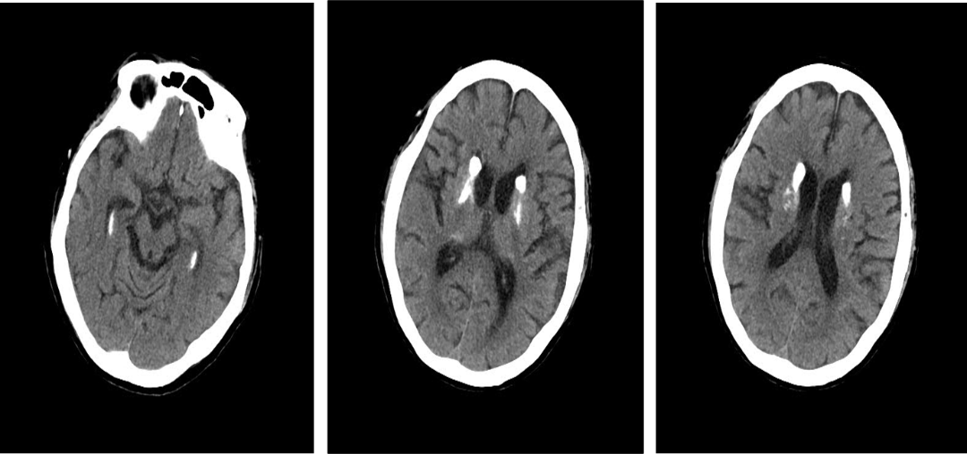 导丝怎么扩重磅！NOVA颅内药物球扩支架湖北首例植入！_https://www.jmylbn.com_新闻资讯_第14张