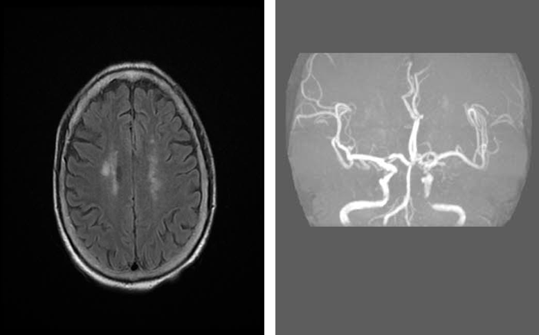 导丝怎么扩重磅！NOVA颅内药物球扩支架湖北首例植入！_https://www.jmylbn.com_新闻资讯_第5张