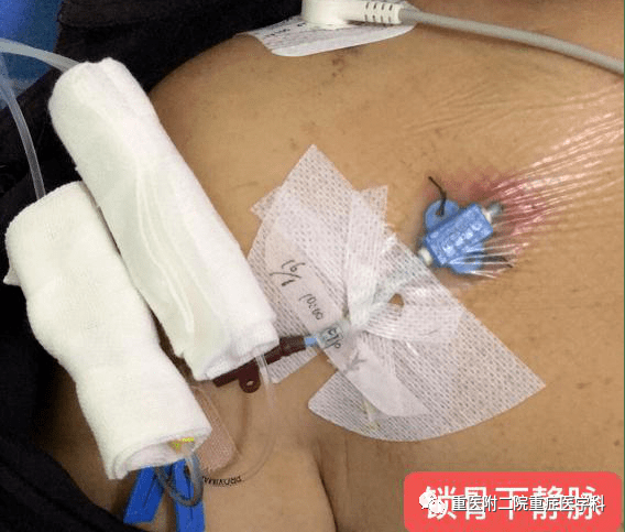 医疗监测性管道有哪些【重症科普你我他】之浅识ICU常见管道_https://www.jmylbn.com_新闻资讯_第22张