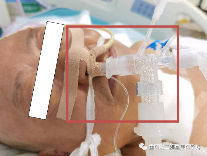 医疗监测性管道有哪些【重症科普你我他】之浅识ICU常见管道_https://www.jmylbn.com_新闻资讯_第10张