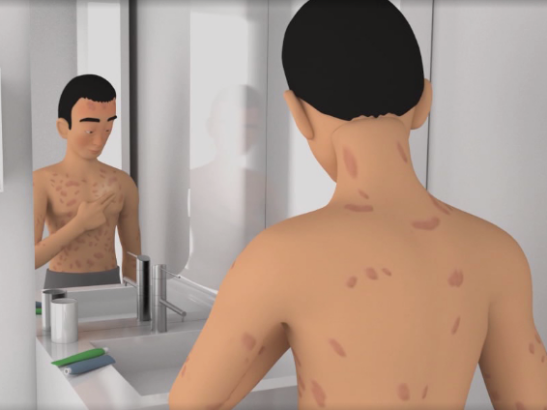 常州京城皮肤病专科医院樊战军：银屑病只是皮肤病？别掉以轻心！