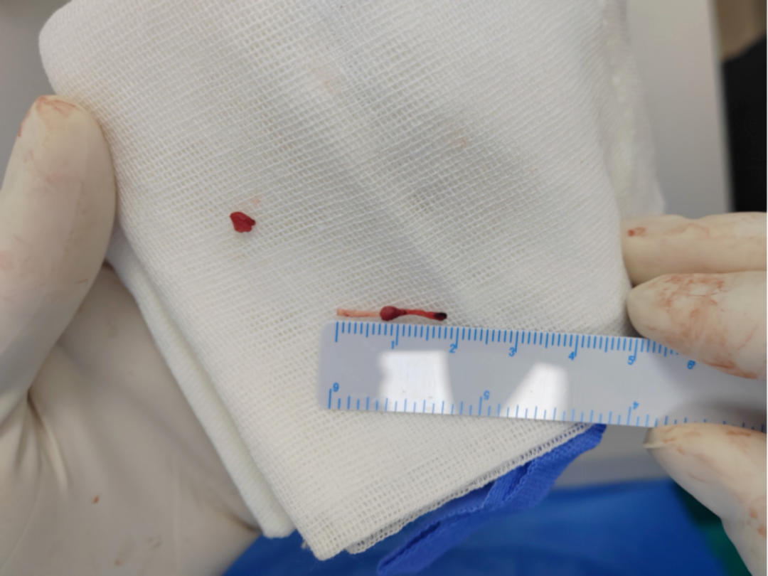 留置针怎么取出患儿留置针软管断裂入血，辗转多家三甲 5 年才取出？！_https://www.jmylbn.com_新闻资讯_第1张