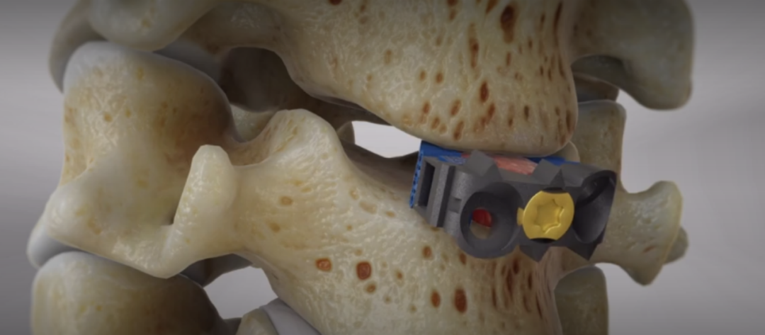 手术耗材是什么急诊患者随时可能截瘫，手术却没有现成耗材，怎么做？_https://www.jmylbn.com_新闻资讯_第7张