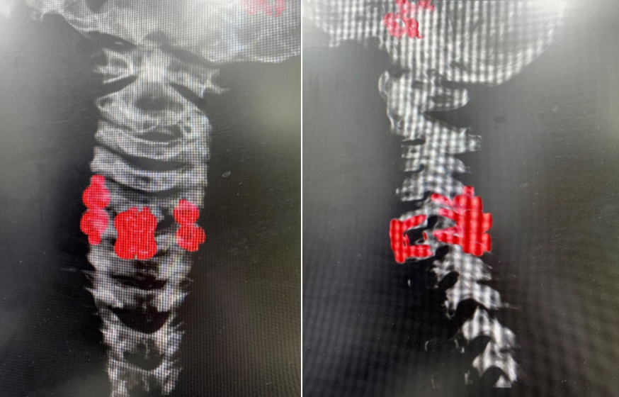 手术耗材是什么急诊患者随时可能截瘫，手术却没有现成耗材，怎么做？_https://www.jmylbn.com_新闻资讯_第9张