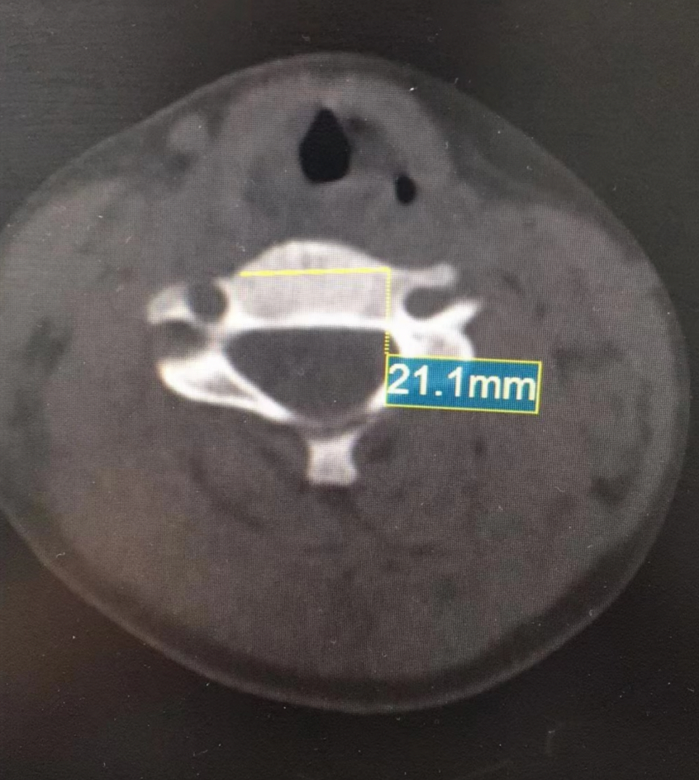 手术耗材是什么急诊患者随时可能截瘫，手术却没有现成耗材，怎么做？_https://www.jmylbn.com_新闻资讯_第4张