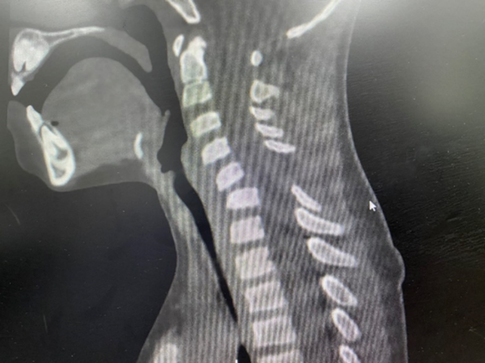 手术耗材是什么急诊患者随时可能截瘫，手术却没有现成耗材，怎么做？_https://www.jmylbn.com_新闻资讯_第3张