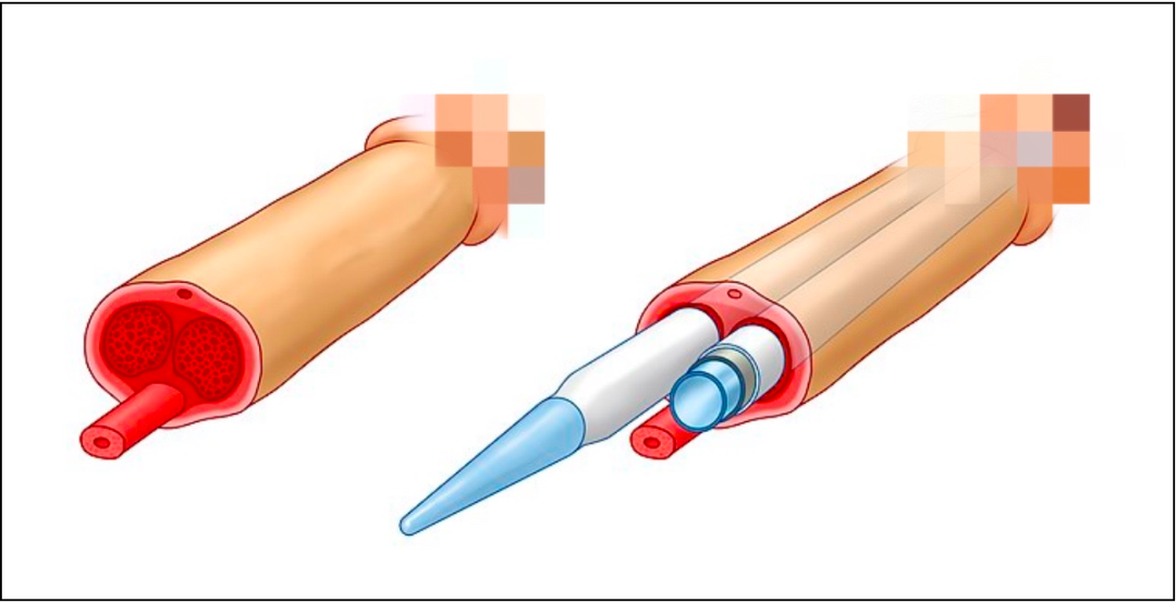 海绵膨胀了怎么办从金枪不倒到收缩自如：可膨胀性阴茎假体成为 ED 治疗「终极武器」之路_https://www.jmylbn.com_新闻资讯_第2张