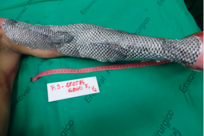 烧伤敷料怎么用图解舌尖上的医学敷料：用罗非鱼皮治疗 II 度烧伤，还能重塑阴道？_https://www.jmylbn.com_新闻资讯_第3张