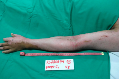 烧伤敷料怎么用图解舌尖上的医学敷料：用罗非鱼皮治疗 II 度烧伤，还能重塑阴道？_https://www.jmylbn.com_新闻资讯_第4张