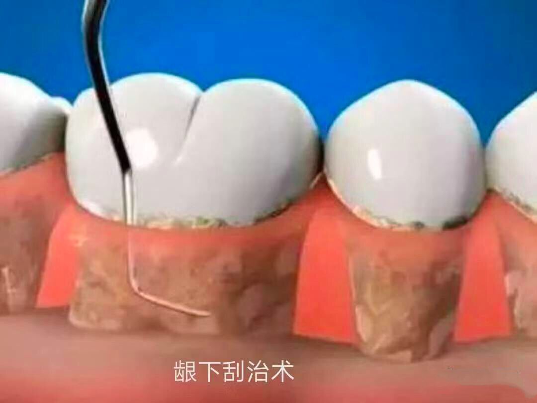 為什麼中國人逃不過「牙齒掉光」的宿命？ 健康 第6張