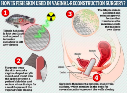 烧伤敷料怎么用图解舌尖上的医学敷料：用罗非鱼皮治疗 II 度烧伤，还能重塑阴道？_https://www.jmylbn.com_新闻资讯_第8张
