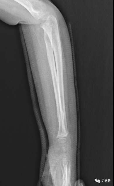 聚酯石膏怎么打6岁孩子的尺桡骨双骨折，就给手术了？外固定架外面还打石膏？_https://www.jmylbn.com_新闻资讯_第19张