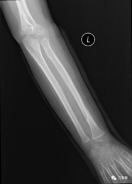 聚酯石膏怎么打6岁孩子的尺桡骨双骨折，就给手术了？外固定架外面还打石膏？_https://www.jmylbn.com_新闻资讯_第20张