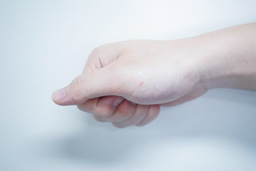 水胶体创口怎么去除创可贴的未来趋势？这个可吸收伤口污染物、促进愈合的敷料你用过吗_https://www.jmylbn.com_新闻资讯_第5张