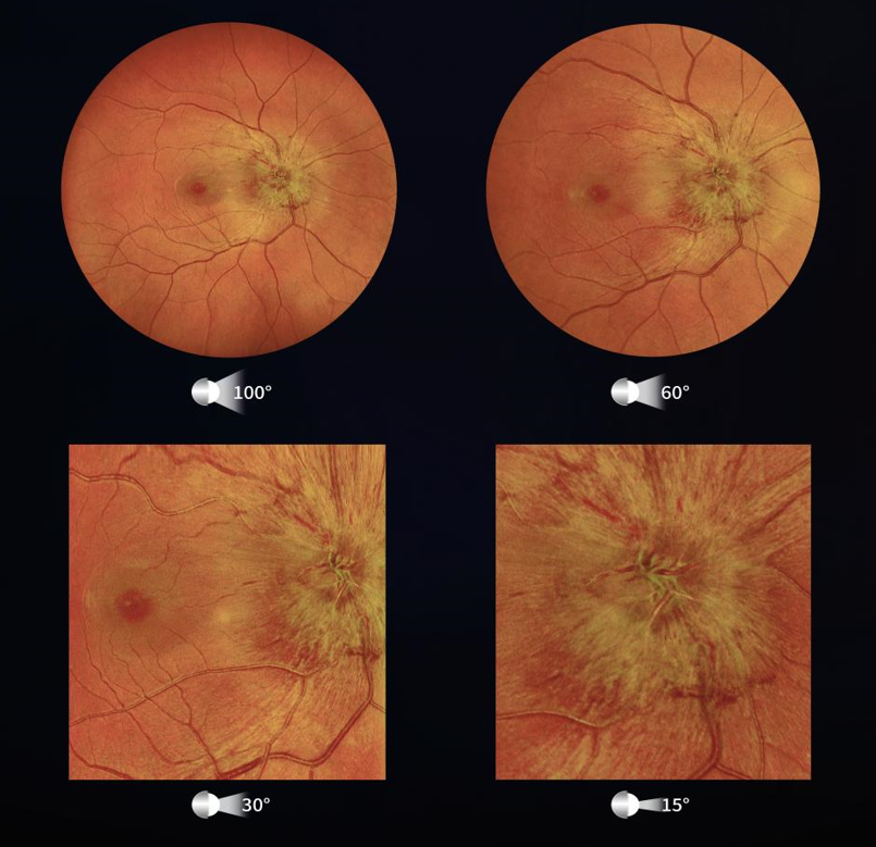 眼底照相能检查出什么免散瞳、快成像！三台县人民医院引进我县首台超广角眼底照相机_https://www.jmylbn.com_新闻资讯_第9张