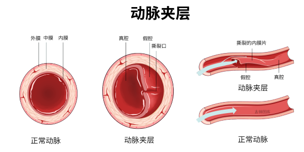 肌钙蛋白升高不要只想到心梗，还有8种情况不可忽略