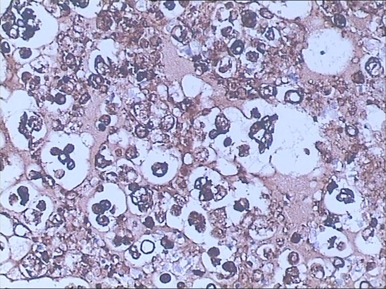 什么是病理蜡块病理细胞蜡块技术是怎样助力对肿瘤追根溯源的？_https://www.jmylbn.com_新闻资讯_第2张