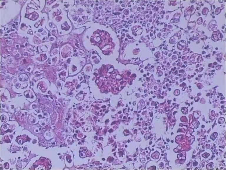 什么是病理蜡块病理细胞蜡块技术是怎样助力对肿瘤追根溯源的？_https://www.jmylbn.com_新闻资讯_第1张